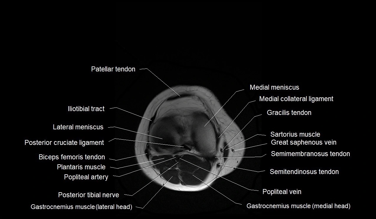 MRI thigh cross sectional anatomy image 59.webp